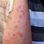 Arlington home inspector on bed bug bites